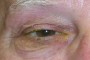 Image showing ptosis (droopy eyelid)