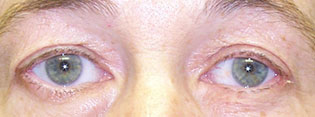 Post-Operative Photograph showing normal upper eyelid position