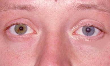 Neurologic conditions associated with Ptosis